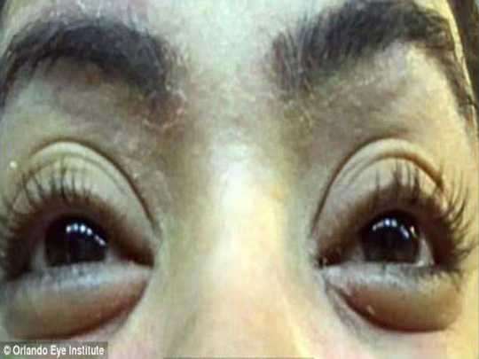 Nhiễm bọ ve trên mí mắt vì... nối mi-1