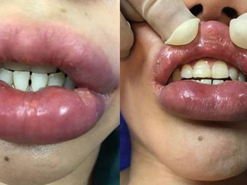 Mê thành mỹ nhân, môi cô gái sưng to như quả chuối