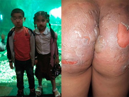 Đi xem đá bóng, hai cháu bé bất ngờ bị tạt cả nồi nước sôi vào người