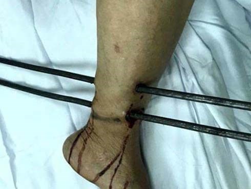 Người bán vé số bị 2 thanh sắt công trình đâm xuyên cẳng chân