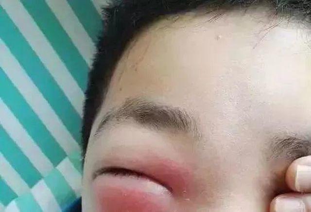 Cậu bé 11 tuổi mắt sưng như trứng, suýt mù vì bố mẹ cho nghịch điện thoại suốt 2 ngày-1