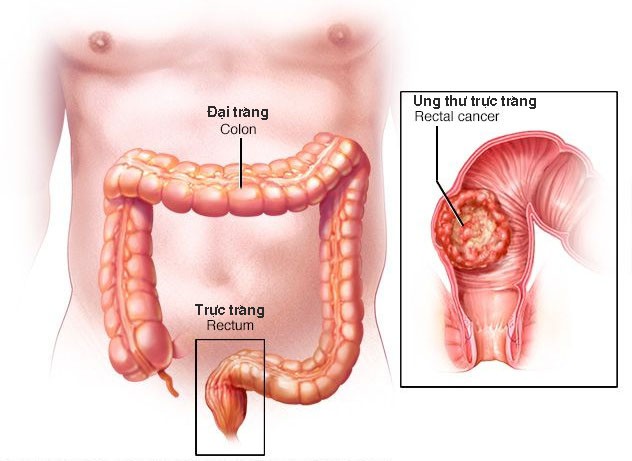 Ung thư đường tiêu hóa, họa từ những món ăn quen thuộc-1