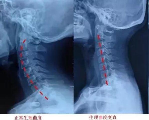 Nhìn phim chụp X-quang cổ của con, mẹ hối hận tột cùng khi trót để con sớm chơi thứ này-1