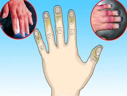 Bỏng lạnh cực nguy hiểm nếu không được sơ cứu đúng cách nhưng mọi người vẫn chưa nâng cao cảnh giác