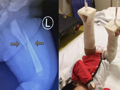 Bé 3 tháng khóc không ngừng khi đi nhà trẻ về, bố sốc nặng khi nghe bác sĩ kết luận