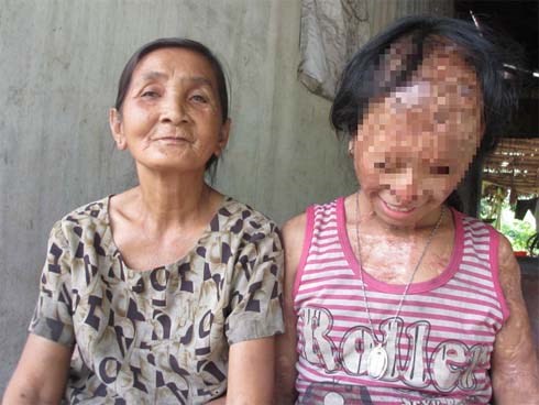 Nghẹn lòng ước mơ của bé gái bị tình địch của mẹ tạt a-xít mù hai mắt