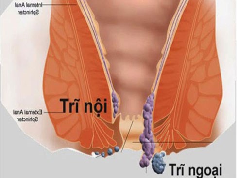 Những điều cần biết về bệnh trĩ: Lưu ý 2 việc tuyệt đối không làm