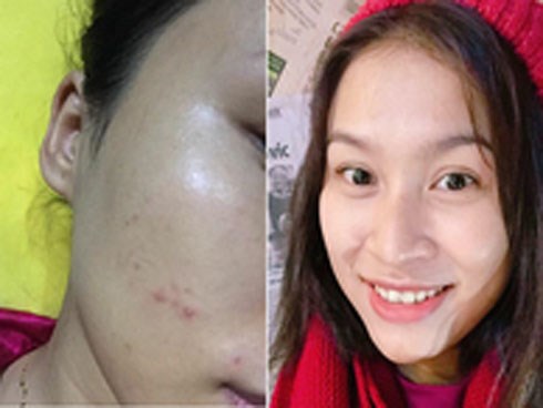Nàng 9x xóa sạch vết thâm, da trắng mịn không tỳ vết với hỗn hợp cực hay dễ thực hiện tại nhà
