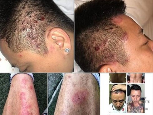 Những lầm tưởng về căn bệnh ca sĩ Tuấn Hưng mắc phải