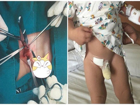Thấy con có khối u nhỏ ở háng nhưng mẹ không bận tâm, đưa con đi khám nghe bác sĩ nói mẹ mới hốt hoảng