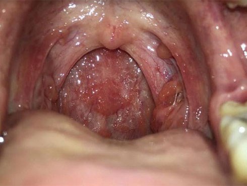 90% người từng bị khô và đau họng sau khi ngủ dậy: Nhớ 8 nguyên nhân phổ biến để tránh