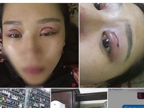 Nghe bạn rủ rê đến spa cắt mí mắt, mẹ trẻ đau đớn khi