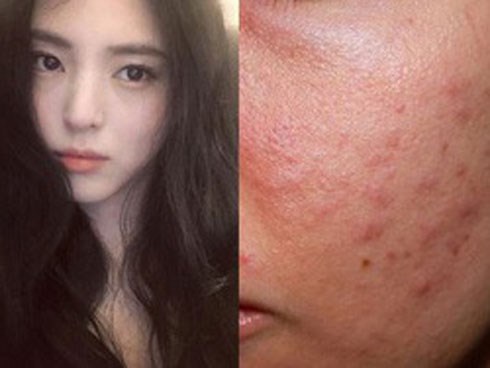 Không sử dụng kem chống nắng hàng ngày là nguyên nhân khiến da bị lên mụn