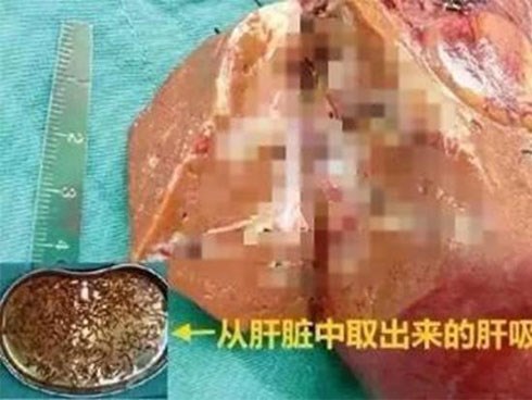 Đi khám họng, ai ngờ lại phát hiện trăm thứ kinh dị trong gan chỉ vì thích ăn món này