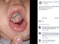 Con có bệnh trong miệng, đau không chịu ăn, mẹ bị mắng tới tấp vì không đưa đi khám còn lên Facebook hỏi 'các mẹ ơi'