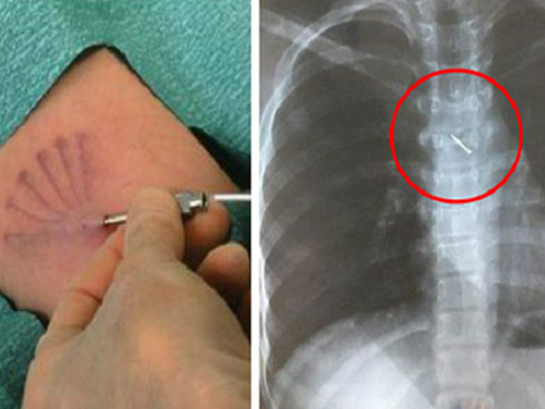 Xuất hiện nhiều trường hợp que tránh thai đi lạc vào tim, phổi… chuyên gia đưa ra cảnh báo không được bỏ qua-4