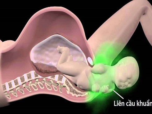 Căn bệnh này có thể lây nhiễm từ mẹ sang con trong quá trình sinh nở khiến trẻ sơ sinh tử vong sau khi chào đời