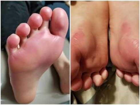 Hốt hoảng khi con kêu “chân như bốc cháy”, đi khám mới biết là do thứ con mặc trên người