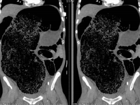 Táo bón 3 ngày không khỏi, người đàn ông khiến bác sĩ kinh hãi khi nhìn phim chụp đại tràng