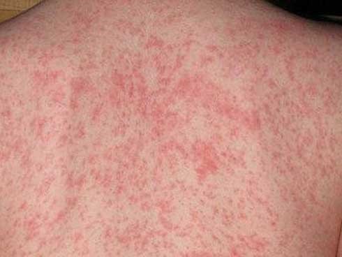 Bệnh sởi đang lan rộng, diễn biến phức tạp tại tỉnh Điện Biên