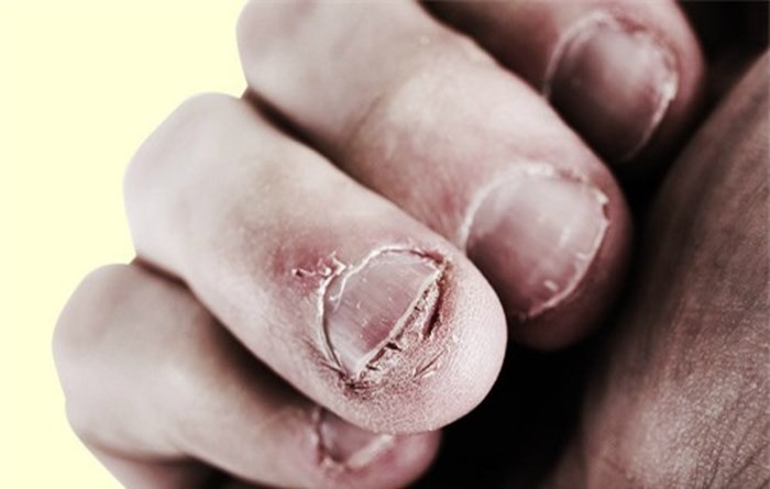 Đừng chủ quan, thói quen cắn móng tay có thể gây ra những hậu quả khôn lường cho sức khỏe mà bạn không ngờ tới-1