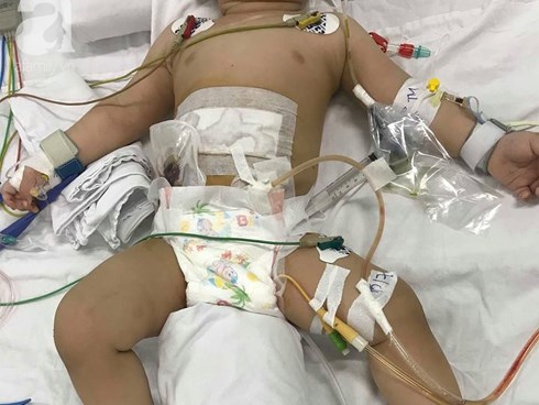 Sau ly hôn, mẹ dùng dao đâm thủng ruột con trai 11 tháng tuổi