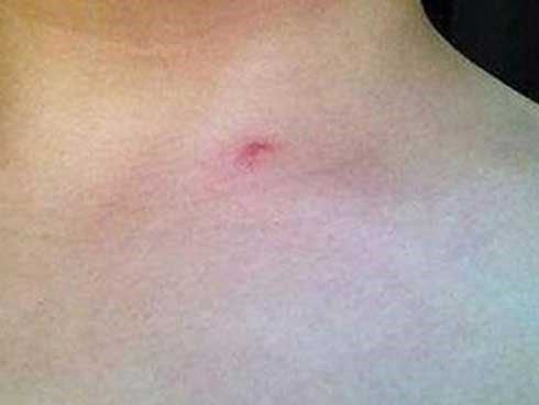 Tưởng vết muỗi đốt trên người, nam thanh niên may mắn thoát nạn khi sớm nghe lời bạn gái