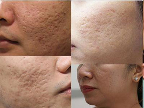 Mặt rỗ như tổ ong bầu cũng được lấp đầy nếu bạn làm việc này mỗi tối-8