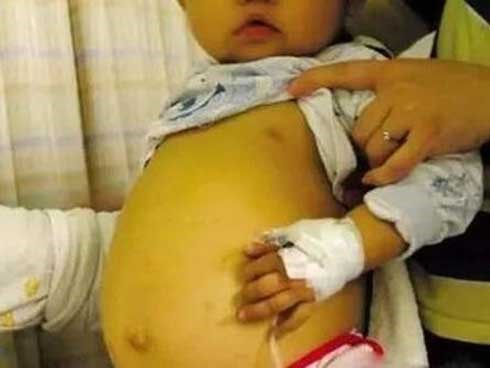 Bé 3 tuổi bụng đầy mủ, thủng ruột vì bà hay cho ăn thứ mà trẻ em nào cũng thích