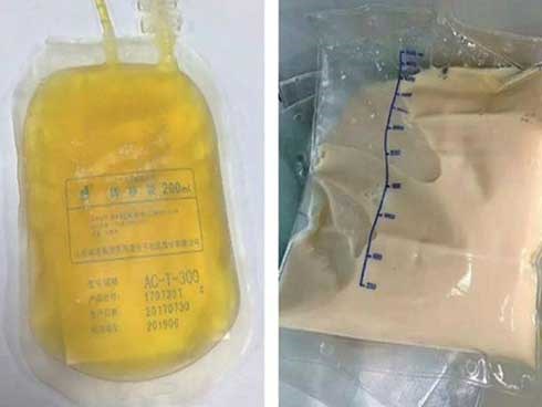 Bác sĩ giật mình khi máu bệnh nhân có lớp váng như mỡ, do ăn những món ai cũng thích