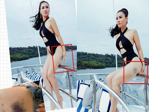 Lộ một bên đùi bầm tím nghi do bị chồng đánh, Thu Minh lên tiếng