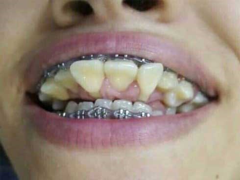 Cư dân mạng Thái Lan phát hoảng với hình ảnh hàm răng bị niềng sai cách dẫn tới biến dạng trầm trọng