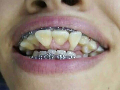 Cư dân mạng Thái Lan phát hoảng với hình ảnh hàm răng bị niềng sai cách dẫn tới biến dạng trầm trọng