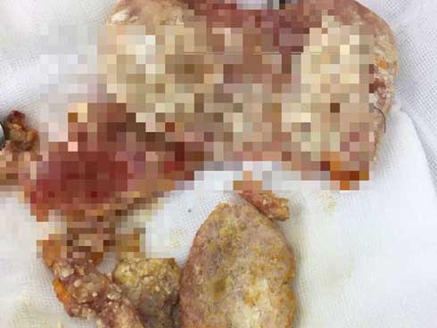 Em kết nghĩa của ca sĩ Quách Tuấn Du bị vỡ túi ngực 2.000 USD trên máy bay, bác sĩ thẩm mỹ biến mất-5