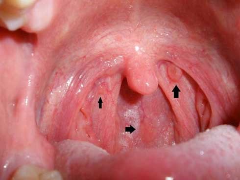 Bệnh ung thư NSƯT Thanh Hoàng mắc phải nguy hiểm thế nào?