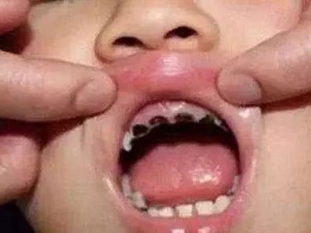 Bé 1 tuổi sâu mòn răng vì thói quen nhiều mẹ Việt hay làm trước giờ đi ngủ của con