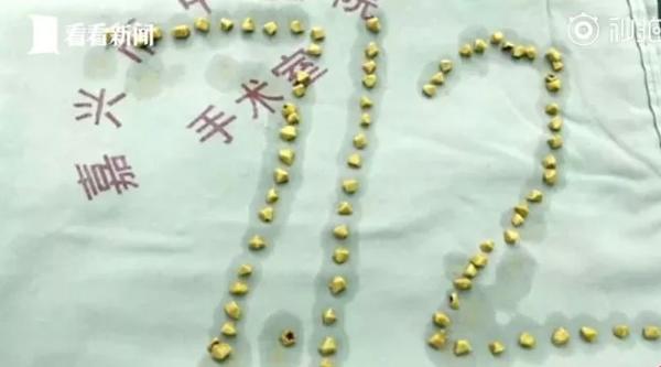Người phụ nữ có gần trăm viên sỏi mật vì thường làm điều này buổi sáng-2