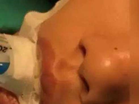 Đứa trẻ 10 tuổi phải phẫu thuật não, chỉ vì mẹ nặn mụn đầu đen ở mũi