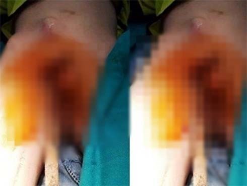 Nhảy từ trên tường xuống dưới, bé trai 6 tuổi bị thanh sắt đâm xuyên qua người