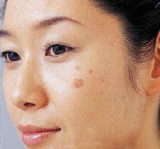 Cô gái 26 tuổi bị ung thư sau khi tẩy nốt ruồi, 10 kiểu nốt ruồi cần đi khám gấp-5