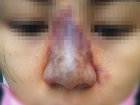 Làm đẹp bằng tiêm chất làm đầy (filler): Tai biến nguy hiểm, khó hồi phục