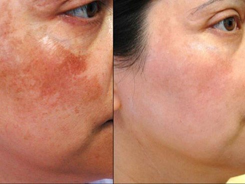 Mỗi ngày bỏ ra chưa đến 5 ngàn để sở hữu 4 cách trị nám da hiệu quả tận gốc