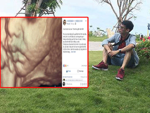 Ông bố 9X nghẹn lòng kể chuyện con trong bụng vợ bị giãn não thất khiến cả MXH rưng rưng