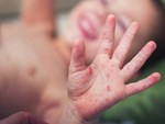 Phụ huynh rối bời vì trẻ bị tay chân miệng ở TP.HCM tăng gấp 5 lần-8