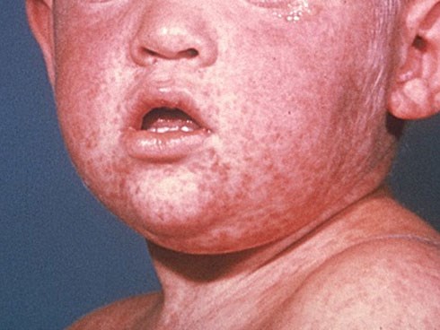 Kiêng nước không vệ sinh khi con bị sởi, chỉ sau vài tiếng răng lợi bị vi khuẩn ăn hết