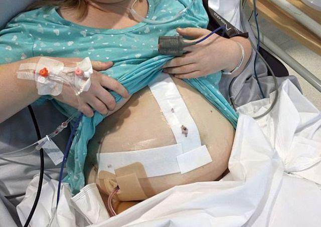 Dùng thuốc tránh thai suốt 12 năm, cô gái phải nhận lấy hậu quả thê thảm-3