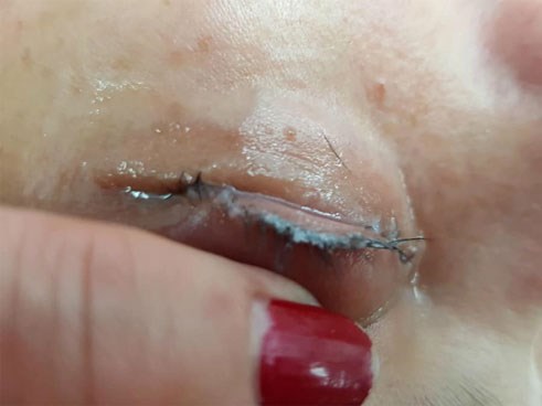 Cô gái đau đớn lĩnh hậu quả với đôi mắt sưng húp, rụng sạch lông mi vì nối mi bằng keo dán sắt