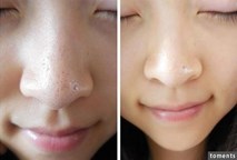 Những cách trị mụn đầu đen ở mũi bằng chanh vừa nhanh vừa đơn giản, lại vô cùng hiệu quả Những cách trị mụn đầu đen ở mũi bằng chanh vừa nhanh vừa đơn giản, lại vô cùng hiệu quả
