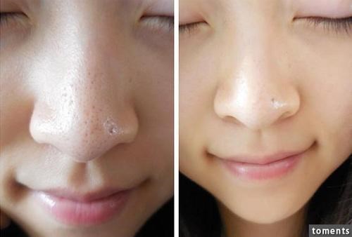Những cách trị mụn đầu đen ở mũi bằng chanh vừa nhanh vừa đơn giản, lại vô cùng hiệu quả