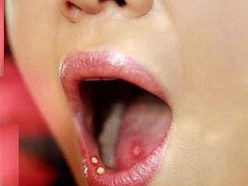 Nhiệt miệng mãi không khỏi, đi khám phải cắt 1/2 lưỡi: cách phân biệt ung thư và nhiệt miệng